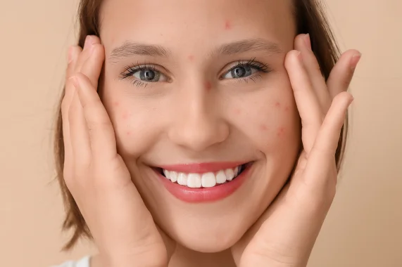 Tratamento para Acne